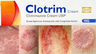 Clotrim Cream uses in Urdu Hindi  Clotrimazole  Fungal Infections [upl. by Feil]