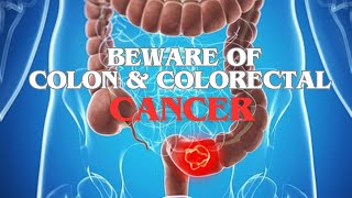 WARNING SIGNS Of Colon And Colorectal Cancer  SEE IF YOURE AT RISK [upl. by Martreb]