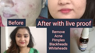 Berberis Aquifolium को कैसे Use करें की आपको सबसे अच्छे Result मिले  for face problem [upl. by Ardnoed305]