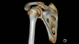 Humerus Greater Tuberosity Fracture [upl. by Anallise320]