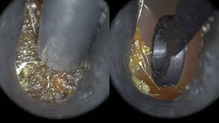 33  Occluding Lateral Ear Wax Removed from Narrow Ear with WAXscope®️ [upl. by Arac840]