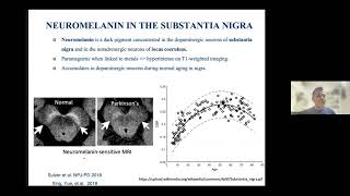 Rahul Gaurav  Abnormal iron concentration in PD in the posteroventral nigral region over time [upl. by Olnton]