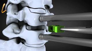 Hernie discale cervicale  Spinal disk herniation  Kisco International [upl. by Llewen]