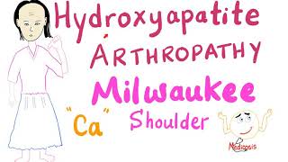 Hydroxyapatite Arthropathy  Milwaukee Soulder [upl. by Barfuss262]