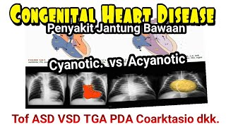 Congenital Heart Disease TOF PDA ASD VSD Coartation Aorta TGA Pulmonary Aortic Stenosis UKMPPD [upl. by Enimzaj935]