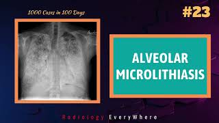 Pulmonary Alveolar Microlithiasis  Radiology Everywhere  1000 cases in 100 days  video 23 [upl. by Eintruoc]