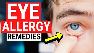 Eye Allergy Remedies  Tips for Itchy and Watery Eyes [upl. by Mharg]