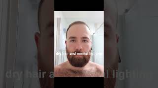 BALDING at 23  Finally Getting A Buzzcut  Part 17 [upl. by Reinald]