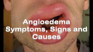 Angioedema  Symptoms Signs and Causes [upl. by Borchers]