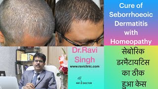 Seborrheic Dermatitis Homoeopathic Cure DrRavi Singh [upl. by Naitsirhk249]