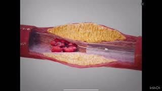 Atherosclerosis Procedure Medicalschooleasylearning [upl. by Rennoc787]