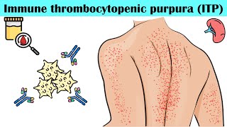 Immune Thrombocytopenic Purpura ITP  Causes Pathogenesis Signs amp Symptoms Diagnosis Treatment [upl. by Opportuna712]