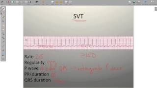 ECG Atrial Rhythms AF AFRVR SVT PAC [upl. by Raphaela]