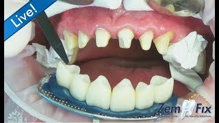 ZemFix®  inserting 6 allceramic zirconia crowns in the upper front [upl. by Gambell]