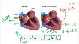 Atrial Fibrillation [upl. by Ainotahs]