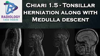 Chiari 15  Tonsillar herniation along with Medulla descent [upl. by Anekam]