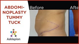 Abdominoplasty  Tummy Tuck [upl. by Dnomyad]