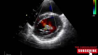 Cleft Mitral Valve with MR [upl. by Enelyak]