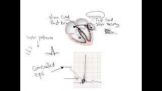 WPW SyndromeExplained [upl. by Lyle]