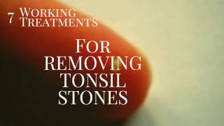 7 smashing treatments for Tonsil stone Removal [upl. by Nilsoj178]