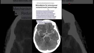 Nimodipine for aneurysmal subarachnoid hemorrhage [upl. by Kirven]