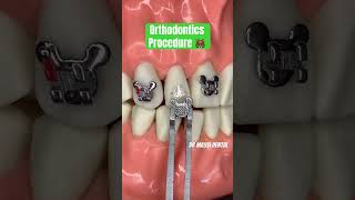 Orthodontics Procedure [upl. by Dewie]