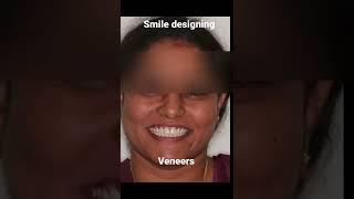 Get rid of fluorosis and gaps Improve your smile with veneers [upl. by Anahoj163]