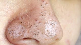 Big Cystic Acne Blackheads Extraction Blackheads amp Milia Whiteheads Removal Pimple Popping  1348 [upl. by Velvet]