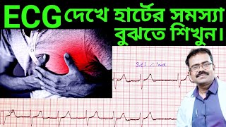 ECG দেখে হার্টের সমস্যা বুঝবেন কিভাবেHow to interpret ECGHow to read ECGElectrocardiogramECG [upl. by Petula]