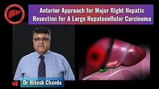 The anterior approach for right hepatectomy for a large hepatocellular carcinoma  Dr Hitesh Chavda [upl. by Nyvek466]