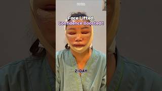 See My Dramatic Facelift Transformation [upl. by Hintze]