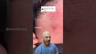 EXTREME ingrown hair drreacts ingrownhair supersatisfying [upl. by Paco]