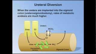 Normal Anion Gap Metabolic Acidosis ABG Interpretation  Lesson 9 [upl. by Suoivatco]