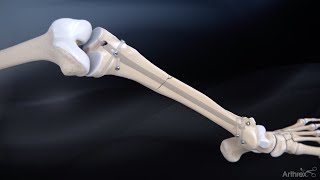 Tibial Nail System—Standard Surgical Technique [upl. by Acsirp937]