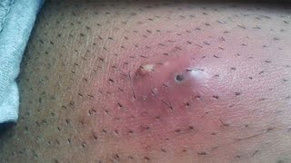 Ingrown hair under arm pit‼️ so many hairs trapped 😱 [upl. by Qifar868]