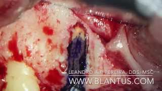 Endodontic Microsurgery [upl. by Bowden]