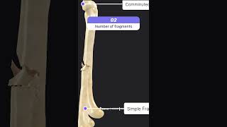 Bone Fractures  Pathology  BioAtlas [upl. by Saffian]