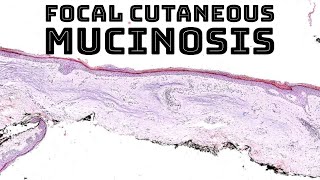 Focal cutaneous mucinosis focal dermal mucinosis pathology dermpath dermatology dermatopathology [upl. by Faun]