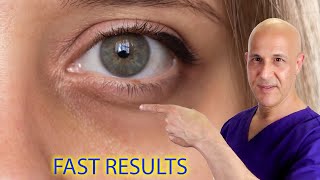 Remove Eye Bags Dark Circles Acne and Get Clear Skin Naturally Dr Mandell [upl. by English]