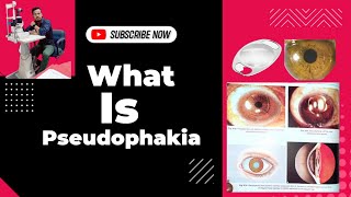 What is pseudophakiasign of pseudophakia symptoms of pseudophakia psedophekic eye ophthalmic [upl. by Eugen]