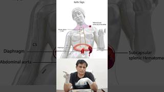 What is Kehr’s Sign Infarction of spleen splenic rupture shorts clinicalanatomyofspleen [upl. by Atikkin]