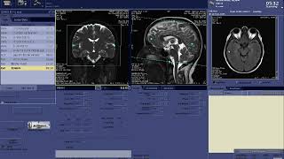 BRAIN MRV Planning with GE Scanner [upl. by Ycrem]