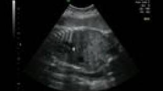 Life in the Womb IV 33 weeks ultrasound [upl. by Anaujahs]