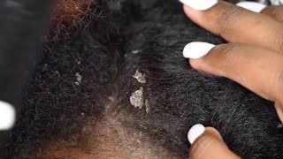 BIG FLAKES  Dry Flaky Scalp  Scratching Dandruff ASMR Ep10 [upl. by Iniffit363]