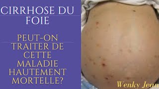 Cirrhose du foie une pathologie à éviter à tout prix causes Conséquence Symptômes Traitement [upl. by Henriette]