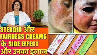 Steroid और Fairness Creams के Side Effects और उनका इलाज [upl. by Anerhs]