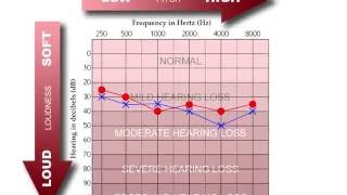 How to Read an Audiogram [upl. by Eng]