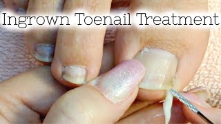 Pedicure Tutorial Ingrown Toenail Treatment At Home How to Recut Nail Groove to Eliminate Pain [upl. by Binetta717]