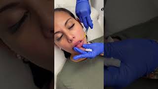 Lip filler cannula technique [upl. by Nahaj]