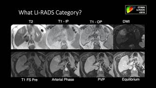 10 LIRADS Ancillary Features  Part 2 QampA By Dr James Lee [upl. by Aneehsat]